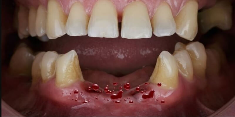 Mơ thấy rụng răng chảy cả máu